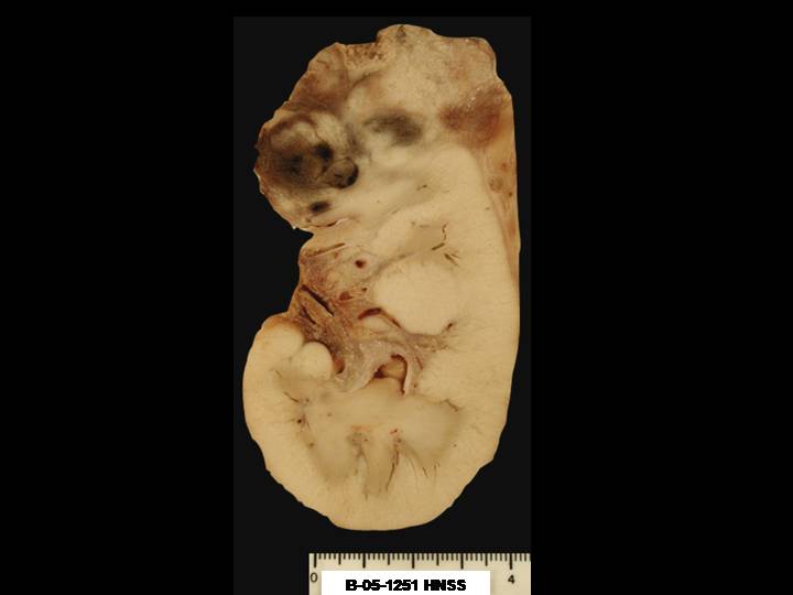 Imagen de Tumor renal infantil / Infantile renal tumor