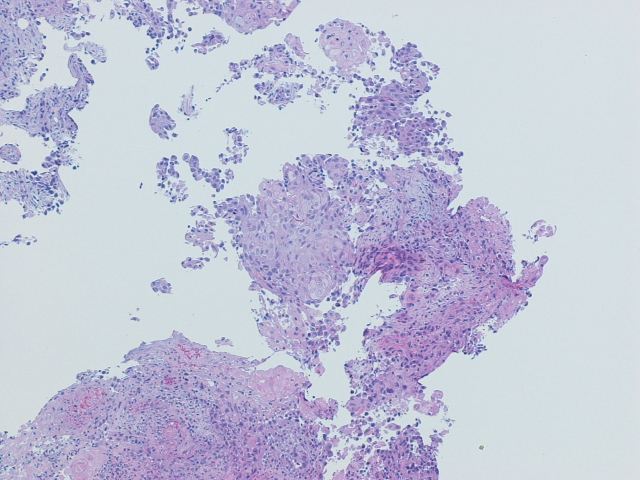 Imagen de Tumoracin en colon sigmoides / Sigmoid colon tumor.