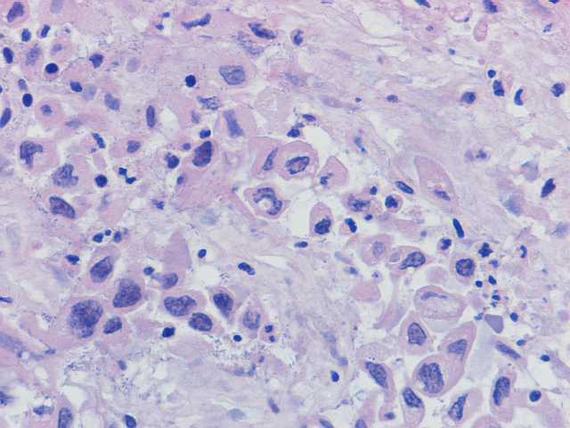 Imagen de Tumoracin en colon sigmoides / Sigmoid colon tumor.