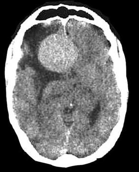 Imagen de Varon de 74 aos con lesion frontal / Frontal lesion in a 74 year old man 