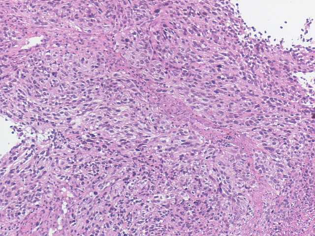 Imagen de Tumoracin rectal en varn de 43 aos / Rectal tumor in 43 years old male.