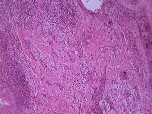 Imagen de Tumor mediastinal en paciente joven/ Mediastinal tumour in young patient.