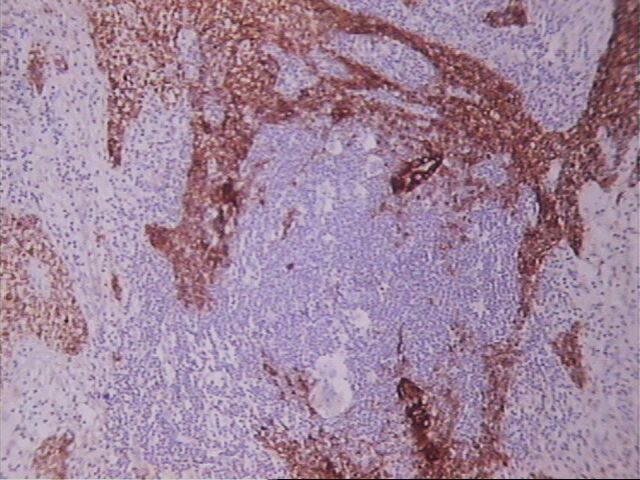 Imagen de Tumor mediastinal en paciente joven/ Mediastinal tumour in young patient.