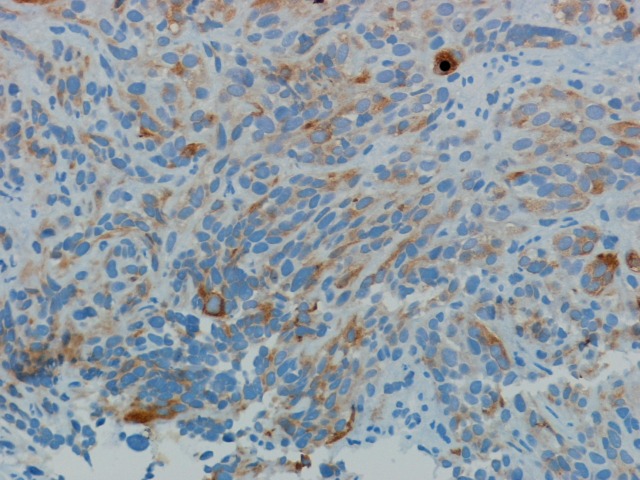 Imagen de Tumoracin rectal en varn de 43 aos / Rectal tumor in 43 years old male.