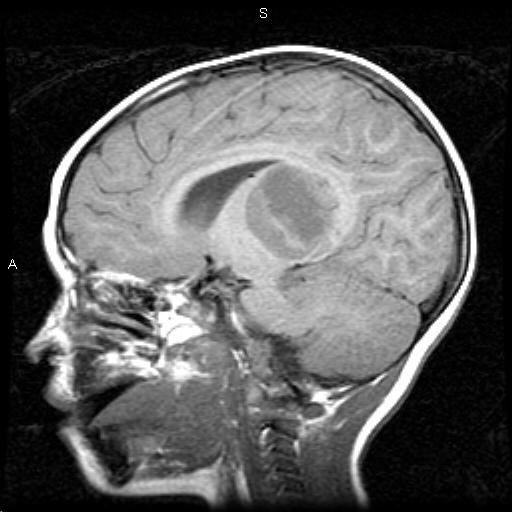 Imagen de Right thalamic cystic mass in a two years old patient.