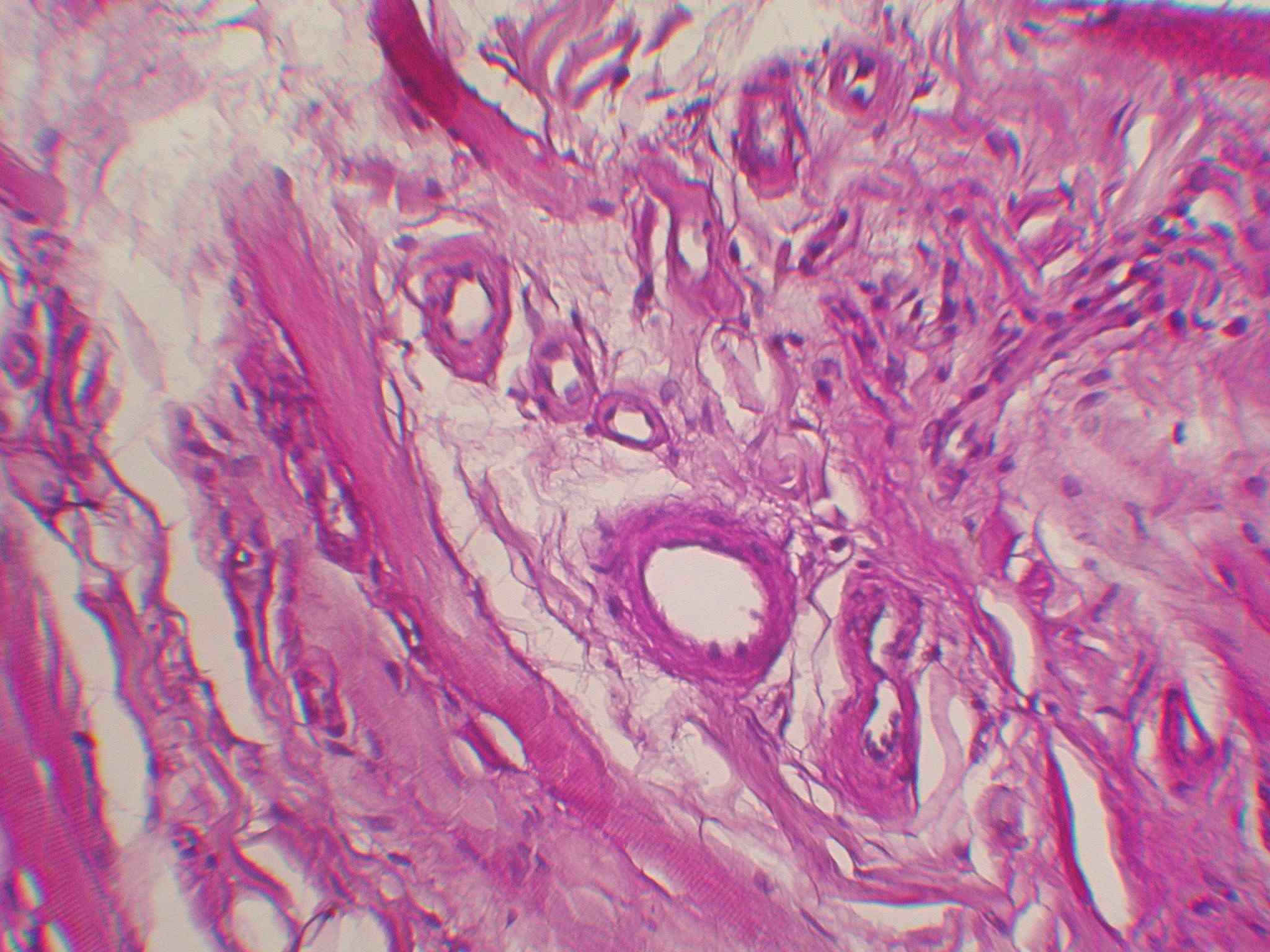 Imagen de Placa blanquecina en mucosa de labio inferior / Whitish patch in lower lip mucosa