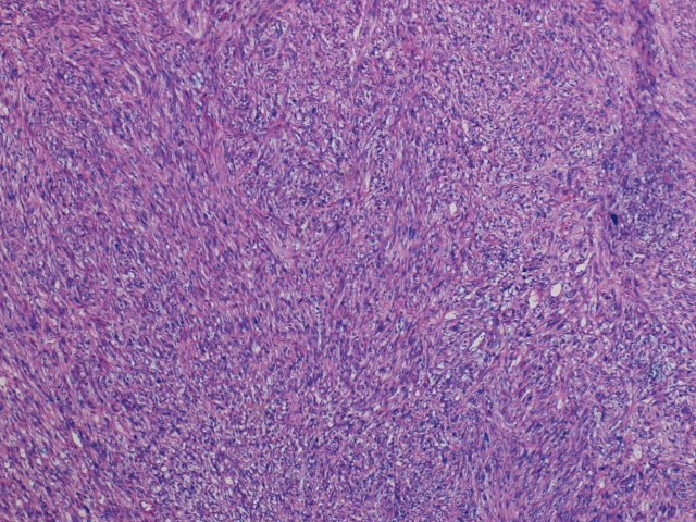 Imagen de Tumor paratesticular en paciente de 64 aos / Paratesticular tumor in 64 y-o patient.