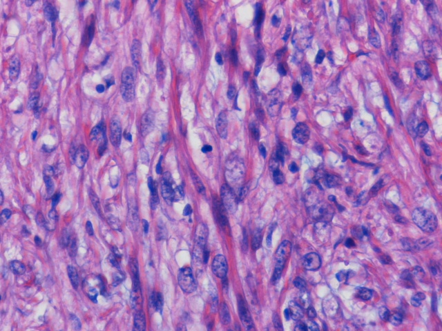 Imagen de Tumor paratesticular en paciente de 64 aos / Paratesticular tumor in 64 y-o patient.
