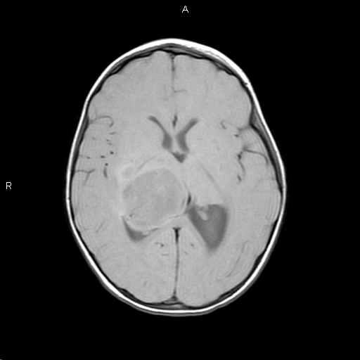 Imagen de Right thalamic cystic mass in a two years old patient.