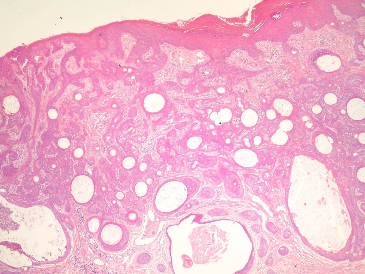 Imagen de Lesin ulcerada en mujer de 76 aos / Ulcerated lesion in 76 y-o female.