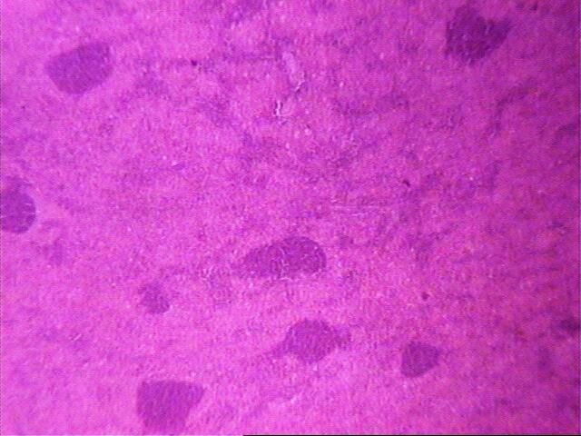 Imagen de Ganglio linftico laterocervical en mujer de 60 aos / Lateral cervical lymph node in 60 y-o female.