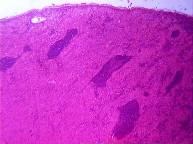 Imagen de Ganglio linftico laterocervical en mujer de 60 aos / Lateral cervical lymph node in 60 y-o female.