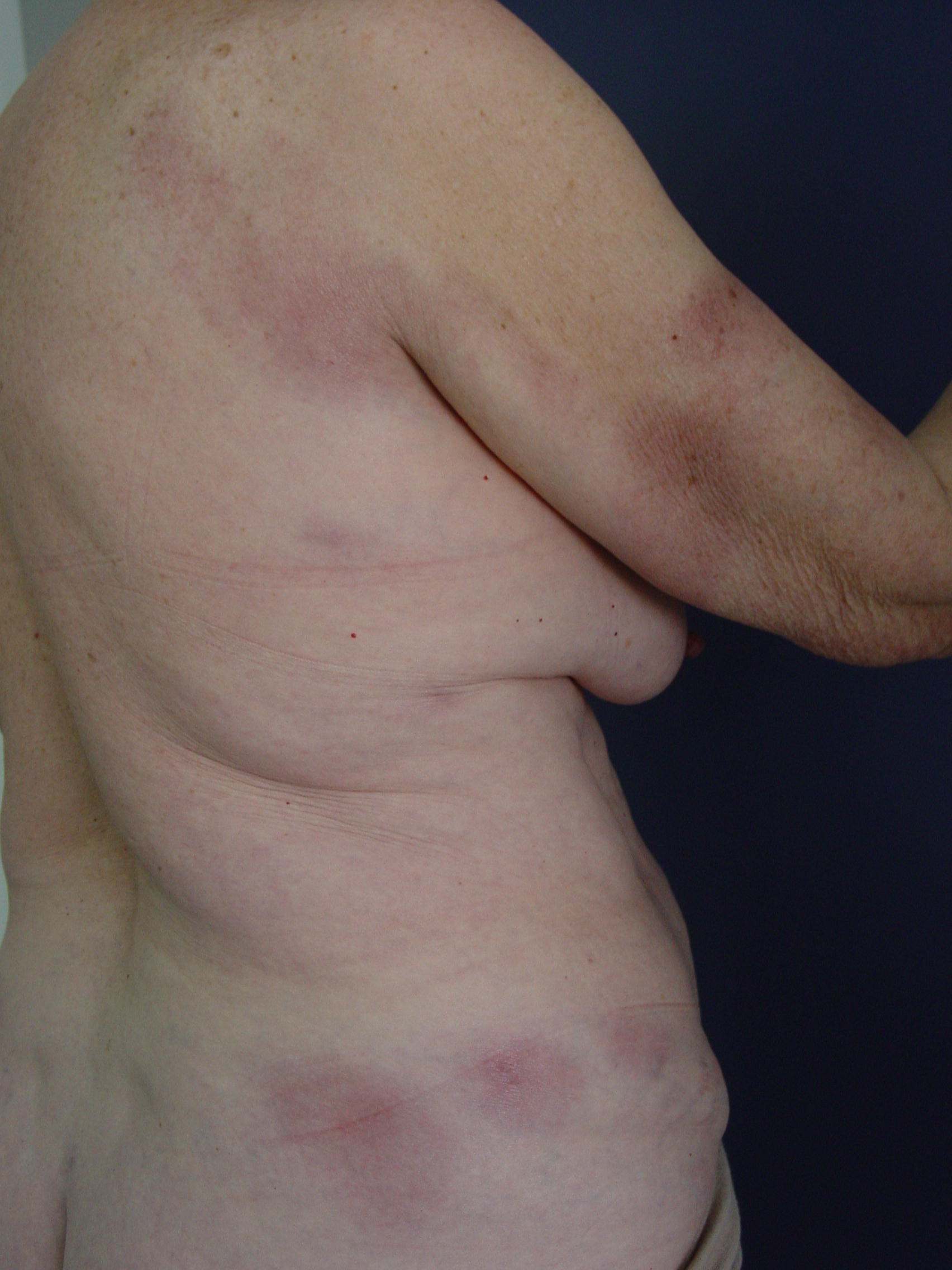 Imagen de Lesiones cutneas en mujer de 56 aos / Cutaneous lesions in 56 y-o female.