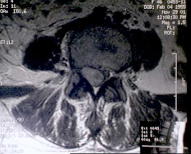 Imagen de Right L4 nerve root mass.