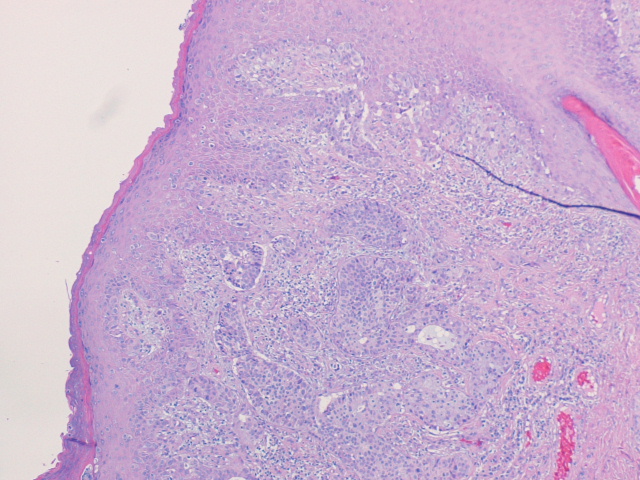 Imagen de Lesin eritemato-escamosa en vulva / Vulvar erythemato-squamous lesion.