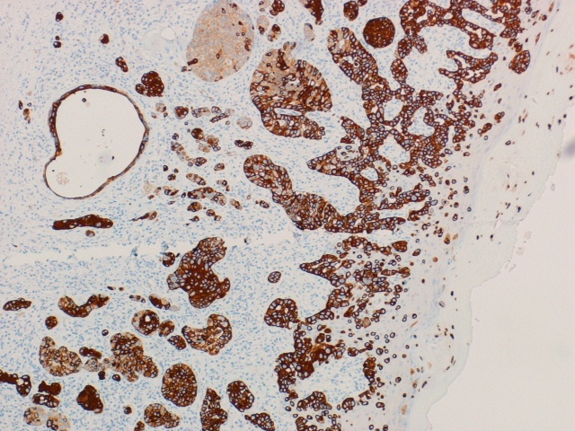 Imagen de Lesin eritemato-escamosa en vulva / Vulvar erythemato-squamous lesion.