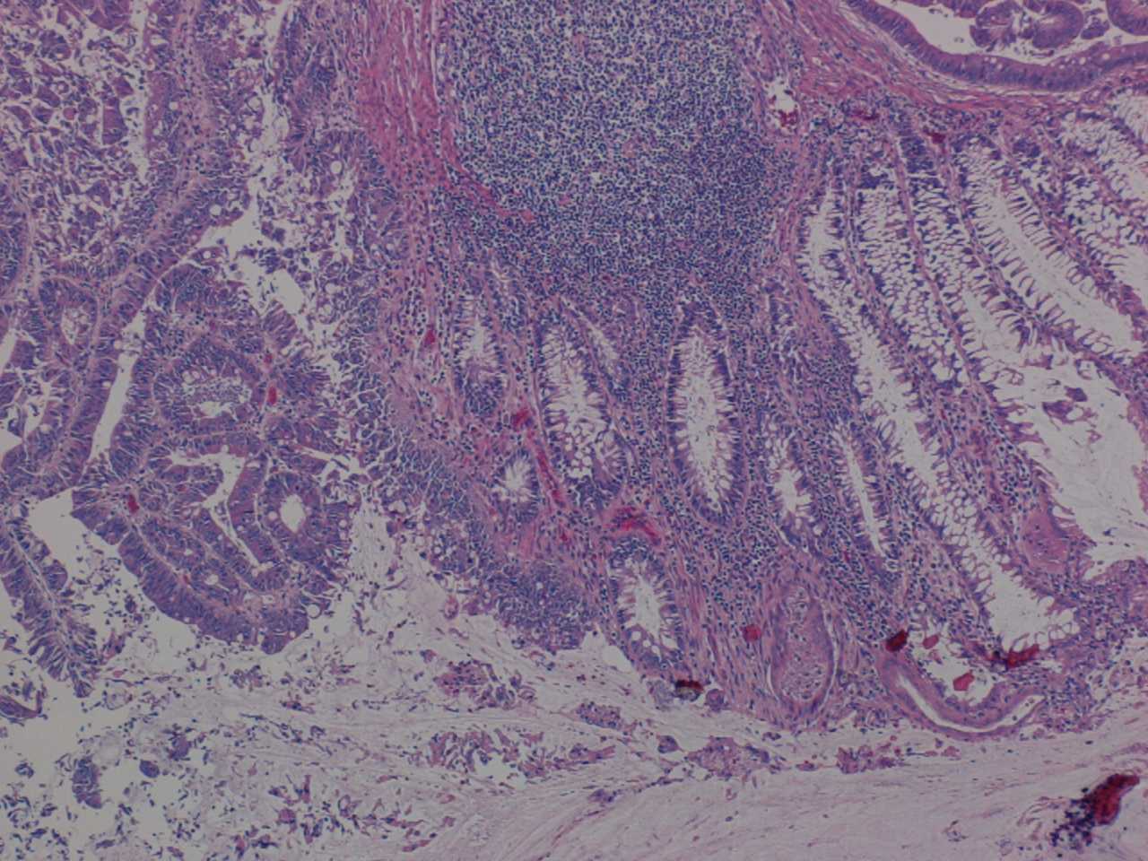 Imagen de Tumores en colon y ovario / Tumors in colon and ovary.