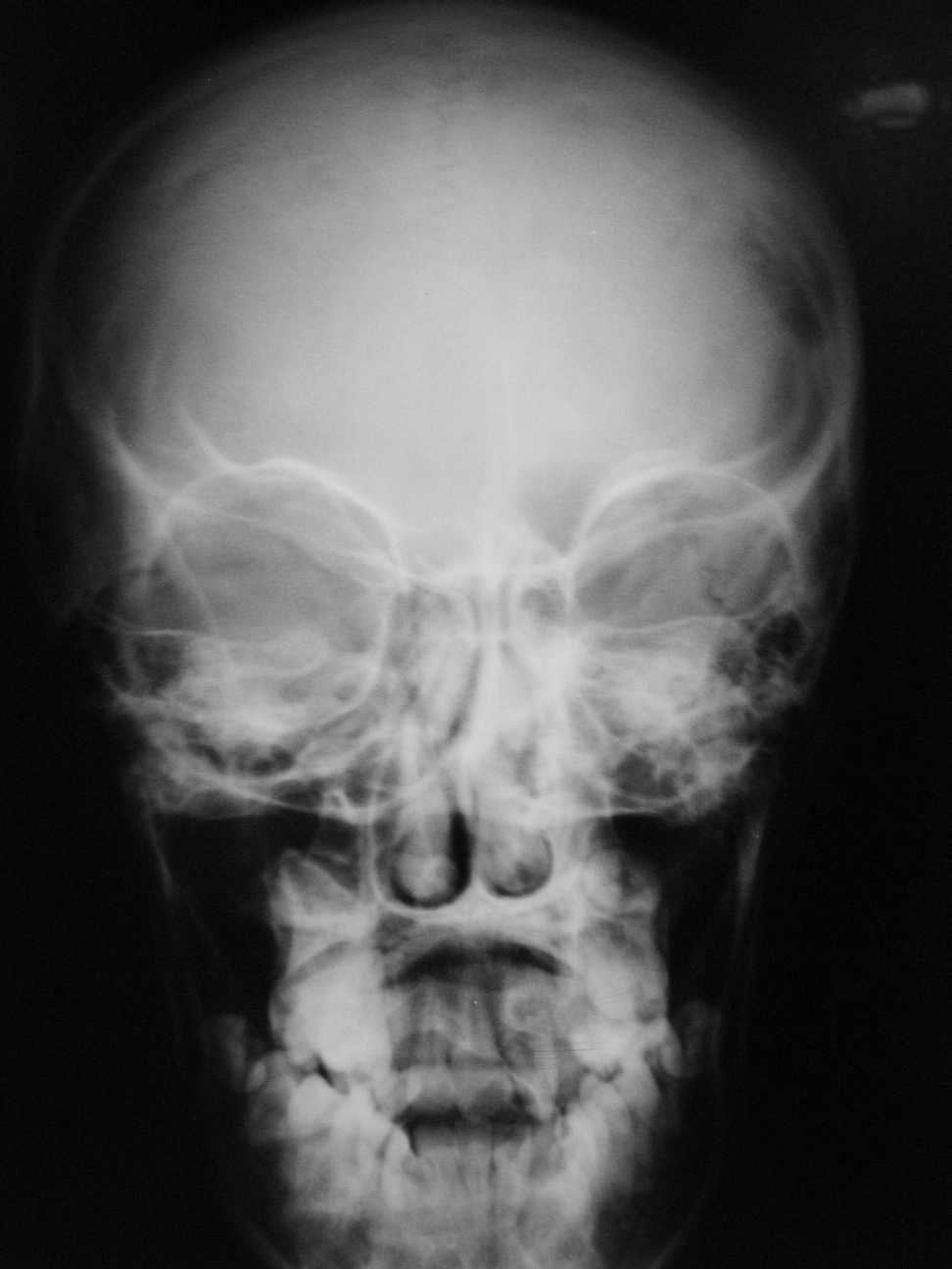 Imagen de Lesin sea parietal izquierda / Left parietal bone lesion.