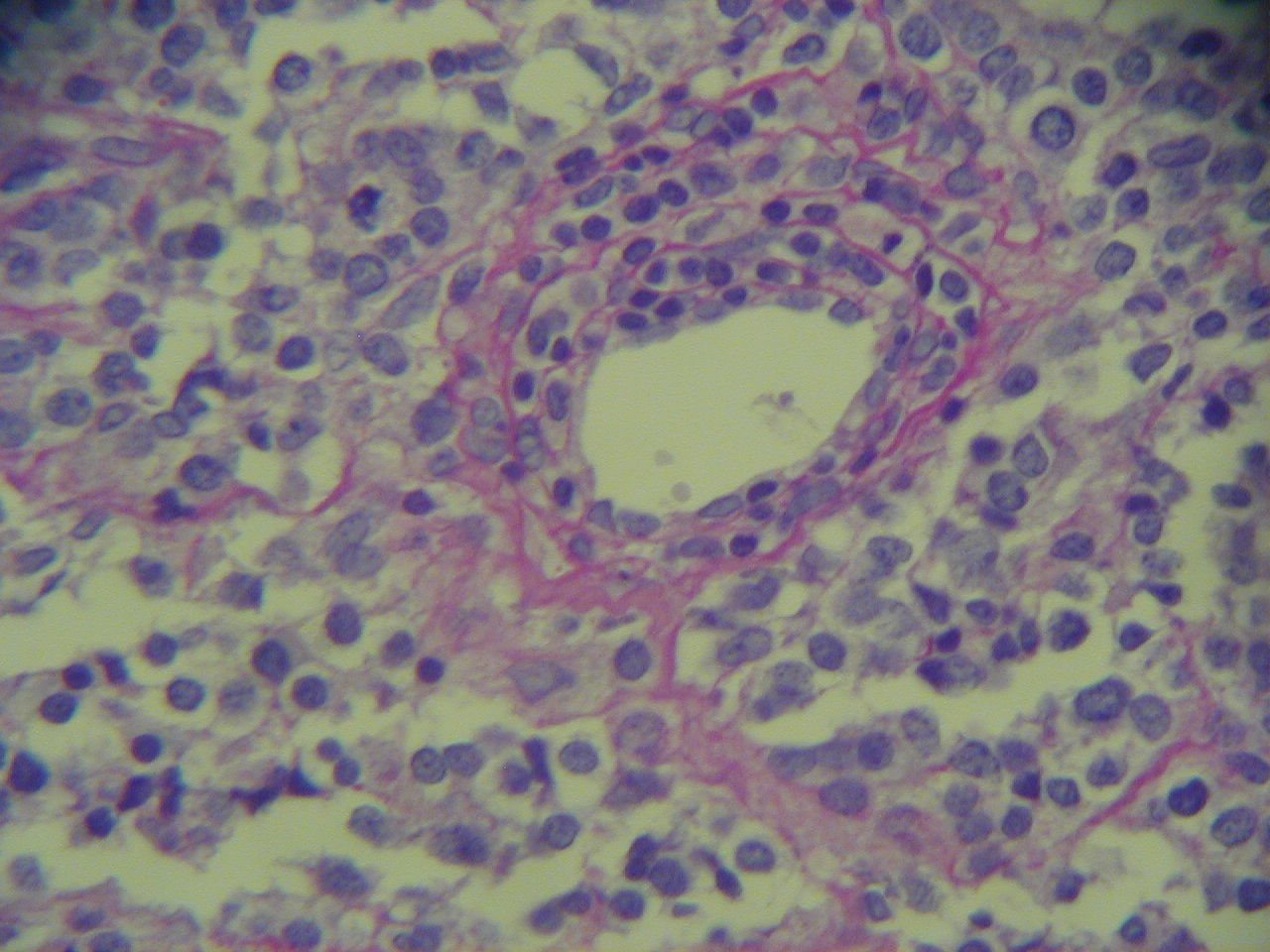Imagen de Tumor mediastnico en mujer de 35 aos / Mediastinal tumor in 35 y-o female.