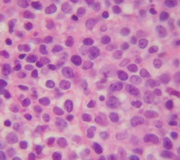 Imagen de Tumor mediastnico en mujer de 35 aos / Mediastinal tumor in 35 y-o female.