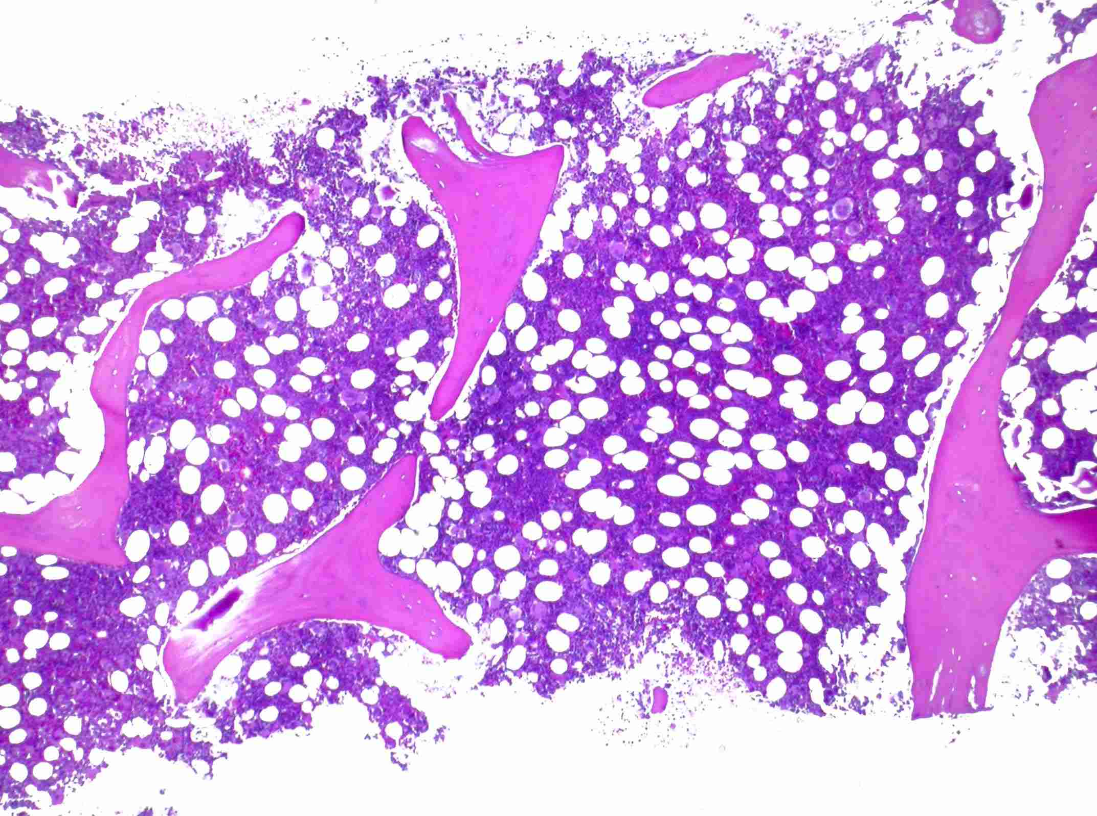 Imagen de Trombocitosis de dos aos de evolucin en paciente femenina adulta joven /  Adult female with thrombocytosis evolving for two years.