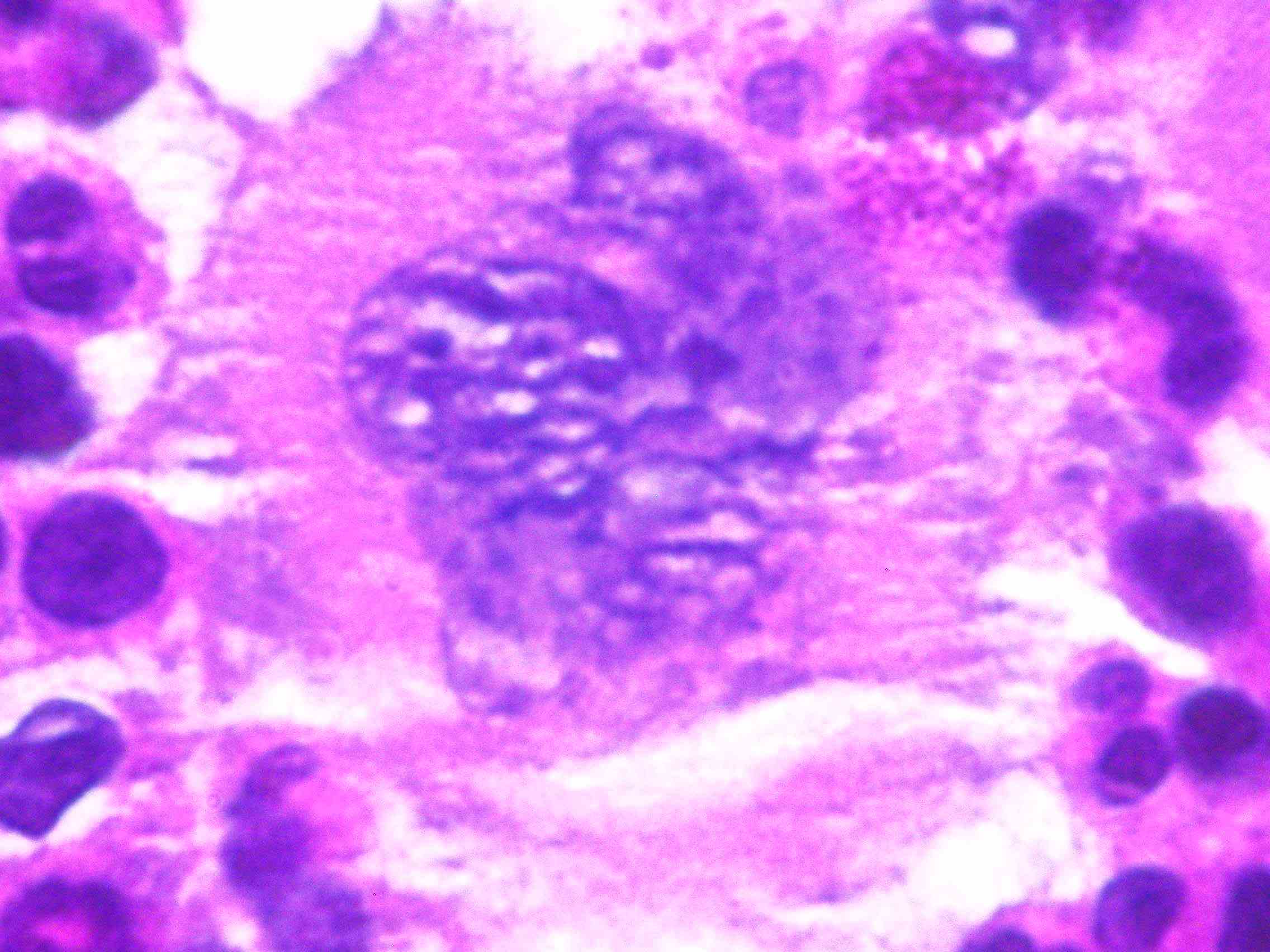 Imagen de Trombocitosis de dos aos de evolucin en paciente femenina adulta joven /  Adult female with thrombocytosis evolving for two years.