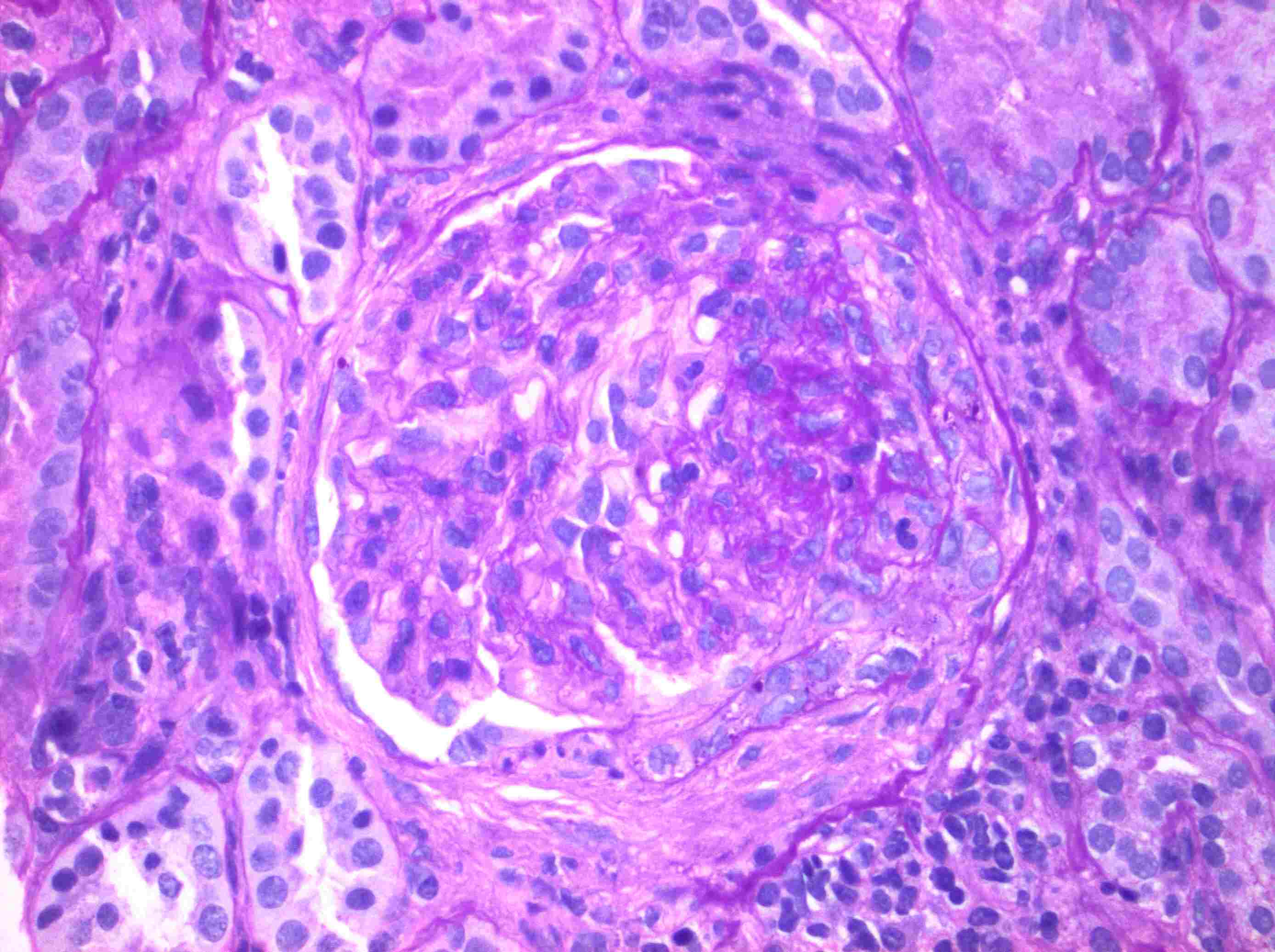Imagen de Deterioro de la funcin renal en varn de 32 aos / 32 y-o male with renal function impairment. 