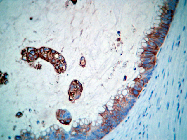 Imagen de Tumoracin plvica en mujer perimenopusica / Pelvic tumor in perimenopausal female.