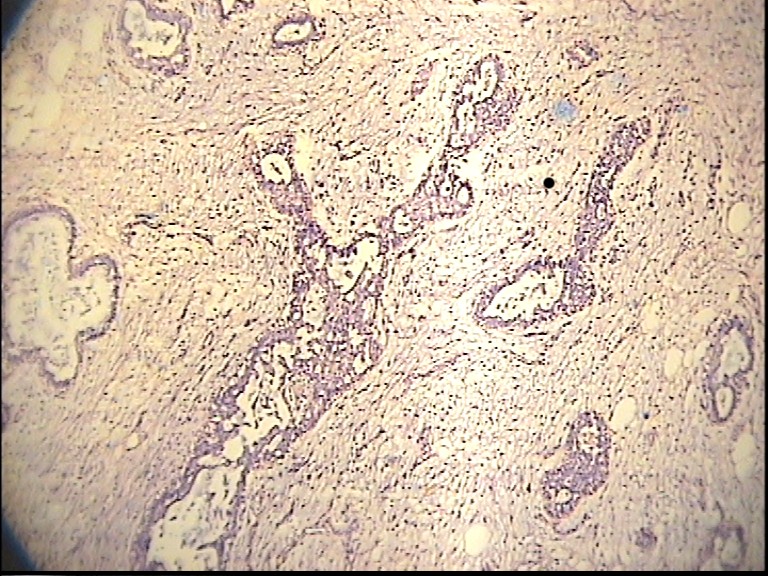 Imagen de Breast mass in 42 y-o female / Tumor mamario en mujer de 42 aos.