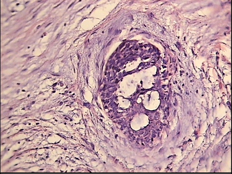 Imagen de Breast mass in 42 y-o female / Tumor mamario en mujer de 42 aos.