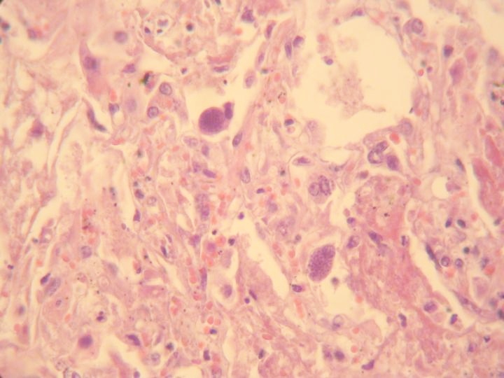Imagen de Sndrome febril tras trasplante de mdula sea / Febrile syndrome after bone marrow transplantation.