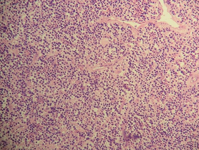Imagen de Tumor retroperitoneal en paciente pediatrico/Retroperitoneal tumor in pediatric patient.