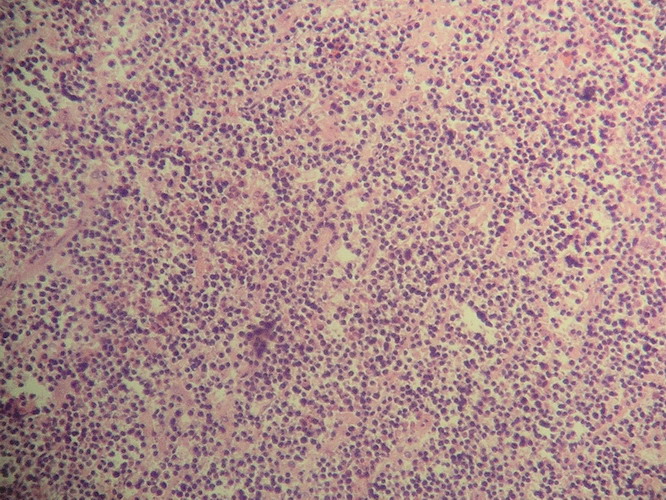 Imagen de Tumor retroperitoneal en paciente pediatrico/Retroperitoneal tumor in pediatric patient.