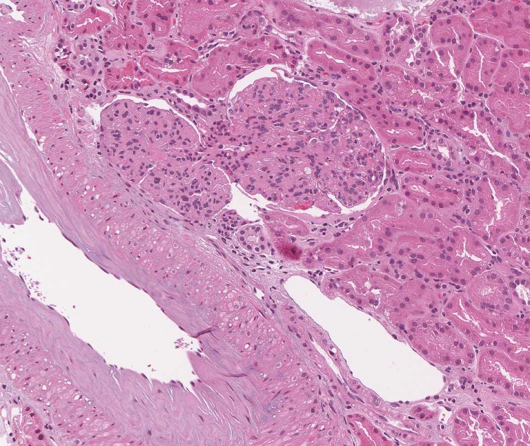 Imagen de Proteinuria en varn de 66 aos / 66 y-o male with proteinuria.