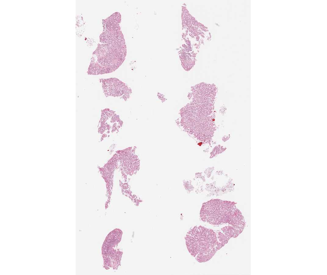 Imagen de Biopsia de colon en mujer de 38 aos/Colon biopsy in 38 year old female.