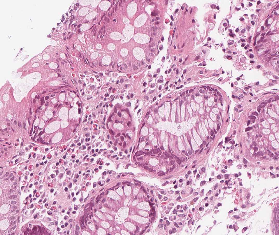 Imagen de Biopsia de colon en mujer de 38 aos/Colon biopsy in 38 year old female.