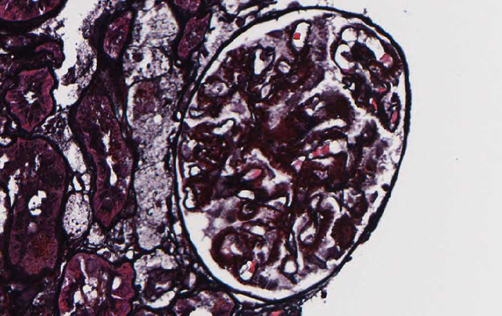 Imagen de Proteinuria de rango nefrtico en mujer de 49 aos/Nephrotic-range proteinuria in 49 y-o female.