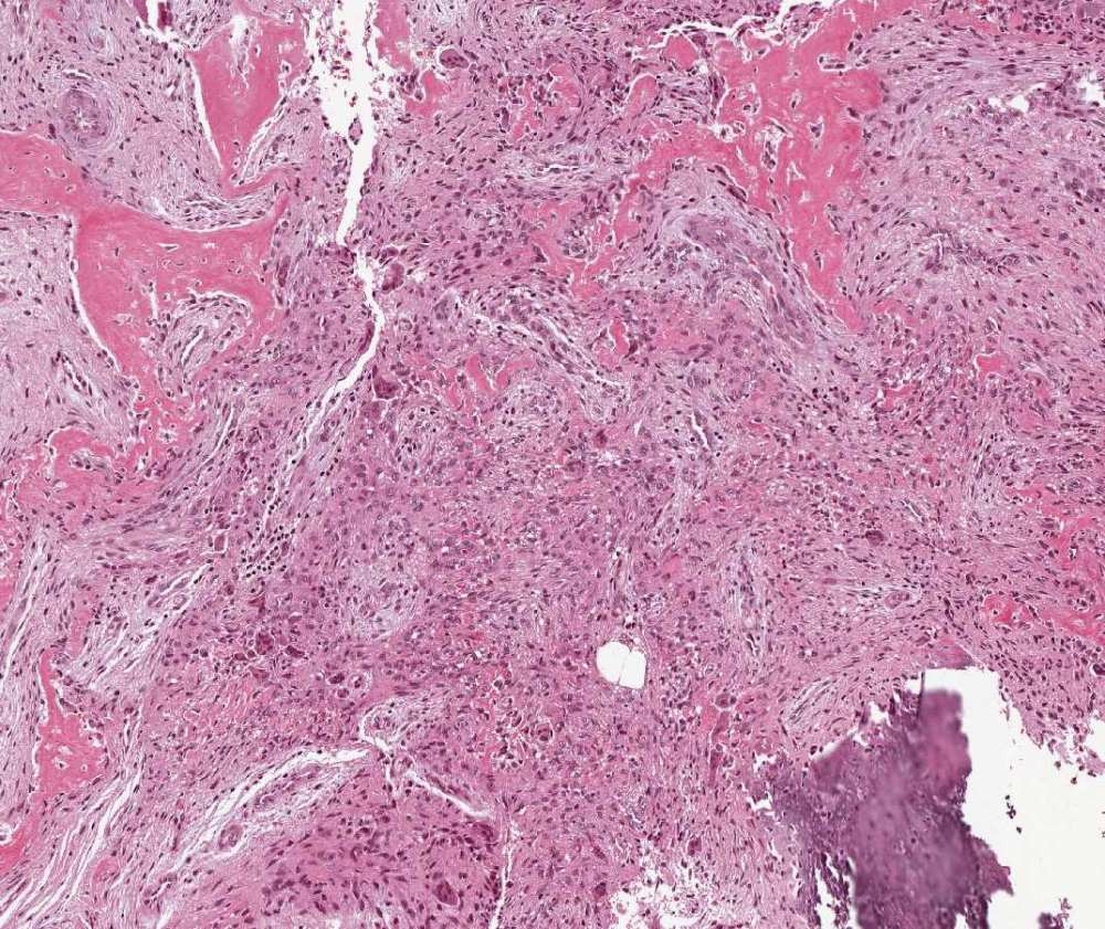 Imagen de Tumoracin en mueca de nia de 15 aos/Wrist tumor in 15 year old girl.