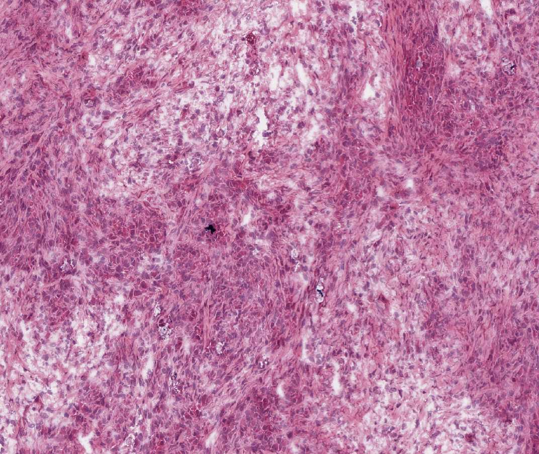 Imagen de Tumor ovrico bilateral en mujer de 36 aos/Bilateral ovarian tumor in 36 y-o female.