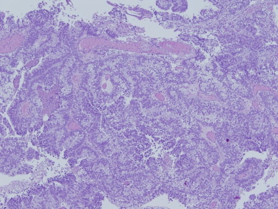 Imagen de Tumor vesical en varn de 81 aos/Bladder tumor in 81 year old male.