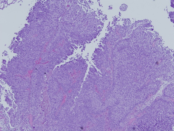 Imagen de Tumor vesical en varn de 81 aos/Bladder tumor in 81 year old male.