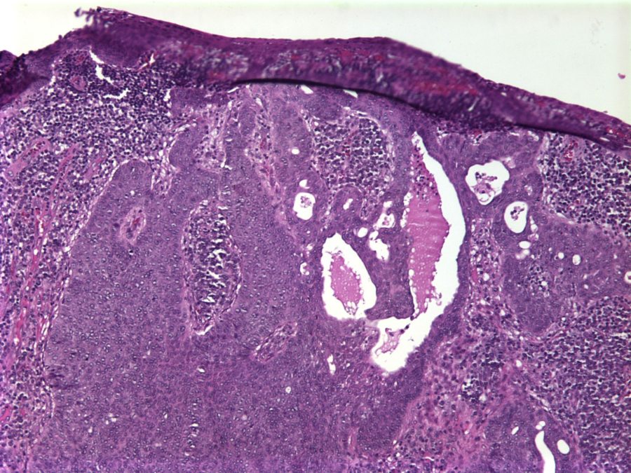 Imagen de Lesin verrucosa en antebrazo / Warty forearm lesion.
