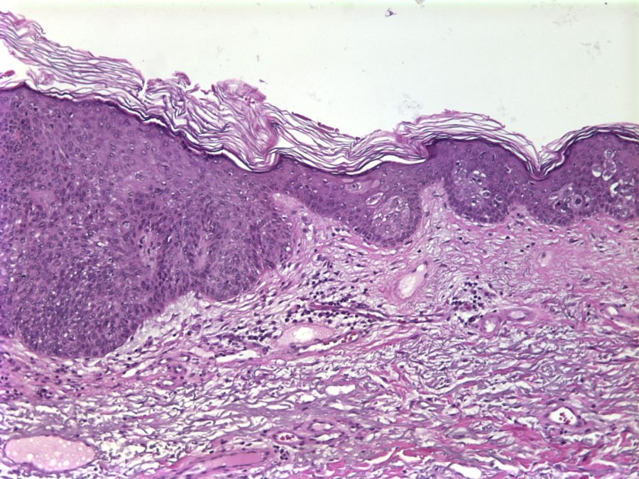 Imagen de Lesin verrucosa en antebrazo / Warty forearm lesion.
