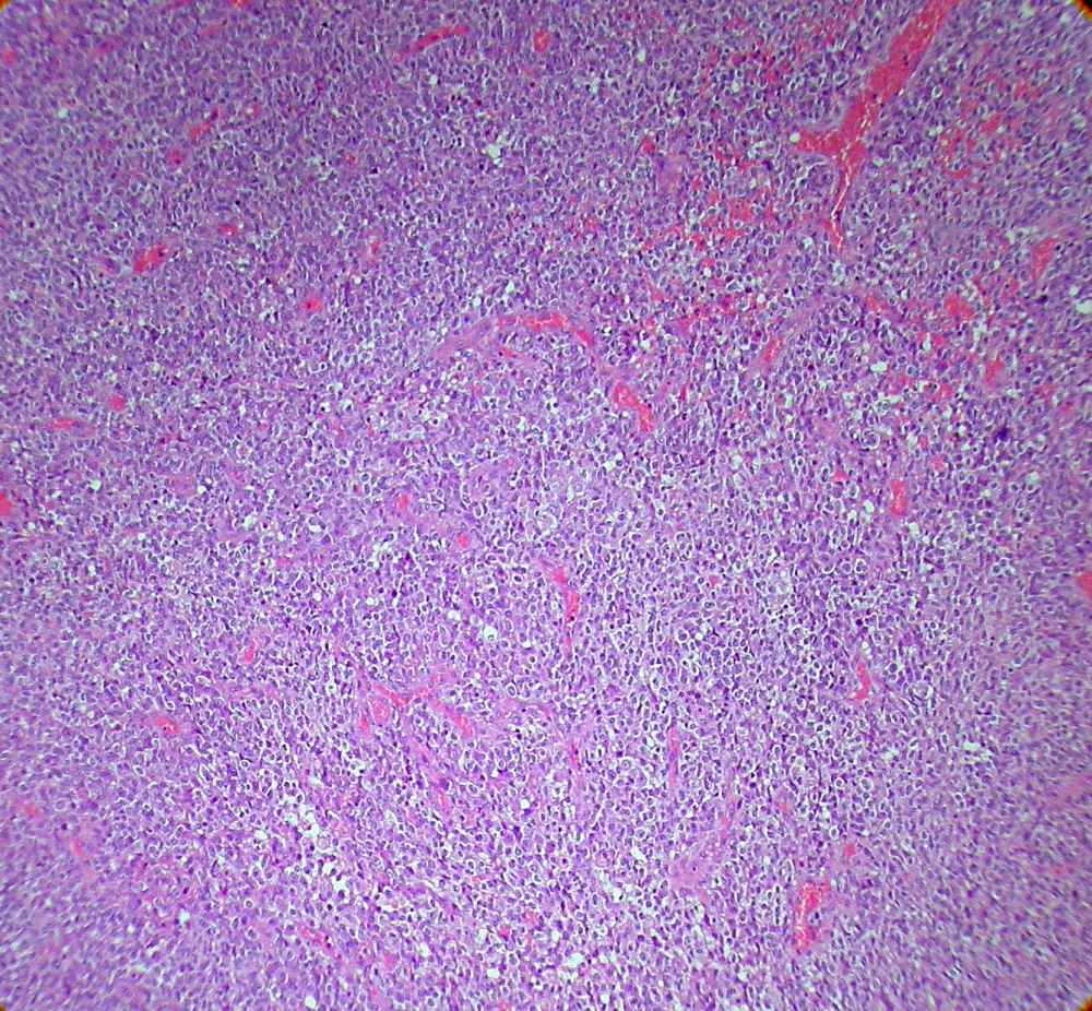 Imagen de Tumor mass of the cerebellopontine angle in a 28 years-old man