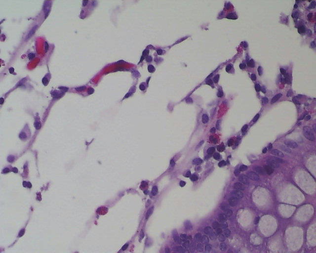 Imagen de Biopsia de colon