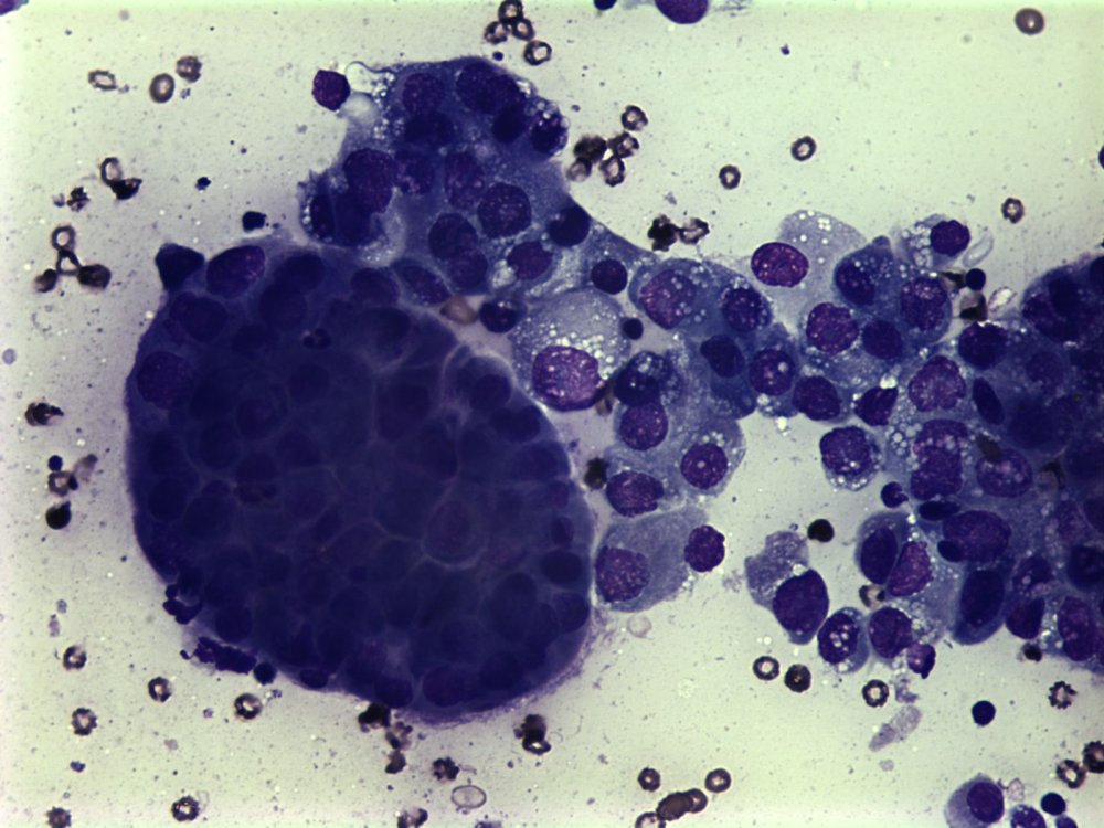 Imagen de Ganglio linftico laterocervical en varn de 70 aos/Lateral-cervical lymph node in 70 y-o male.