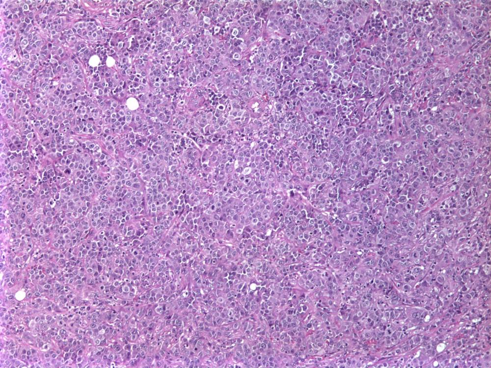 Imagen de Ganglio linftico laterocervical en varn de 70 aos/Lateral-cervical lymph node in 70 y-o male.