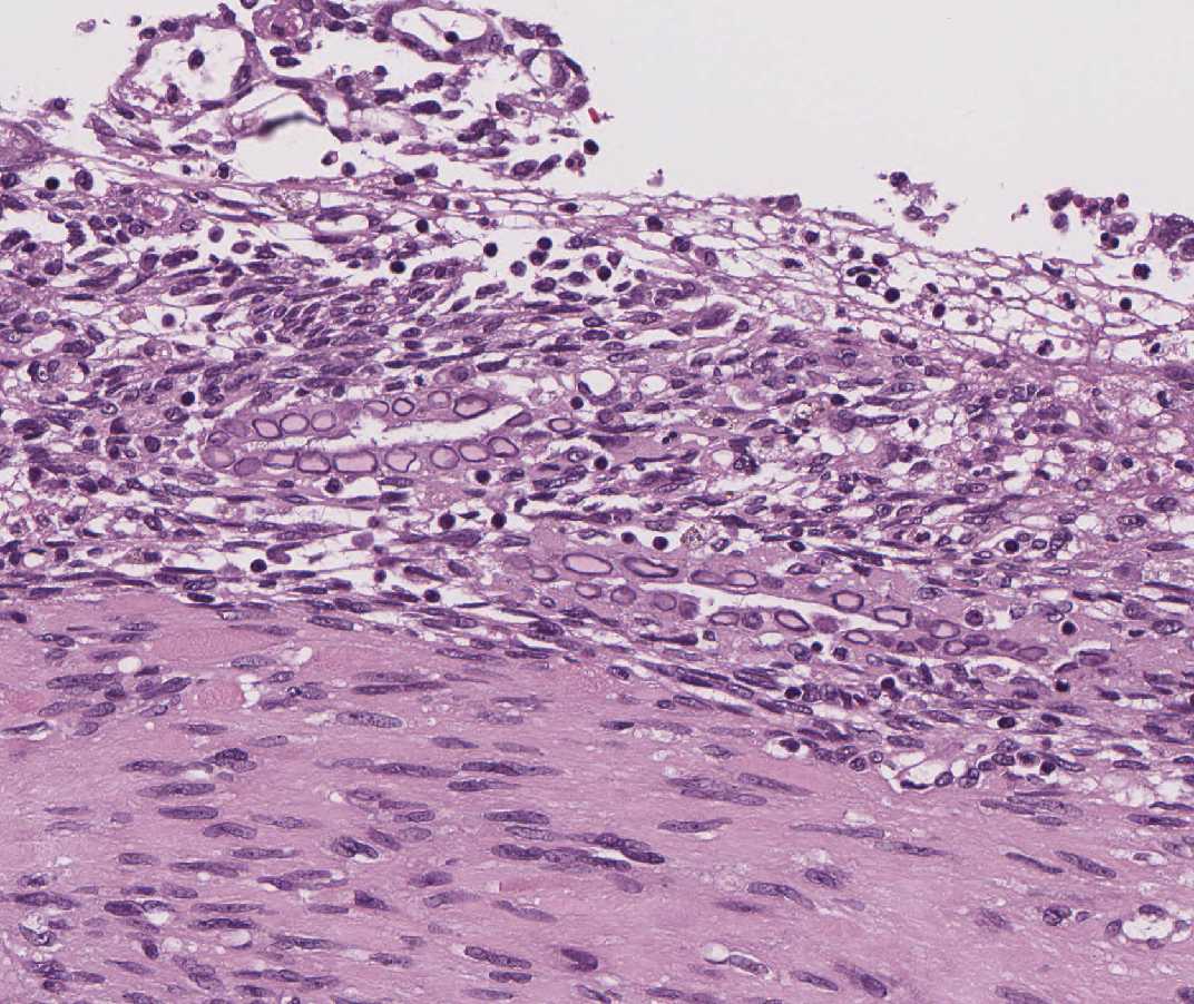 Imagen de Histerectoma procedente de paciente joven/Hysterectomy specimen from young female.