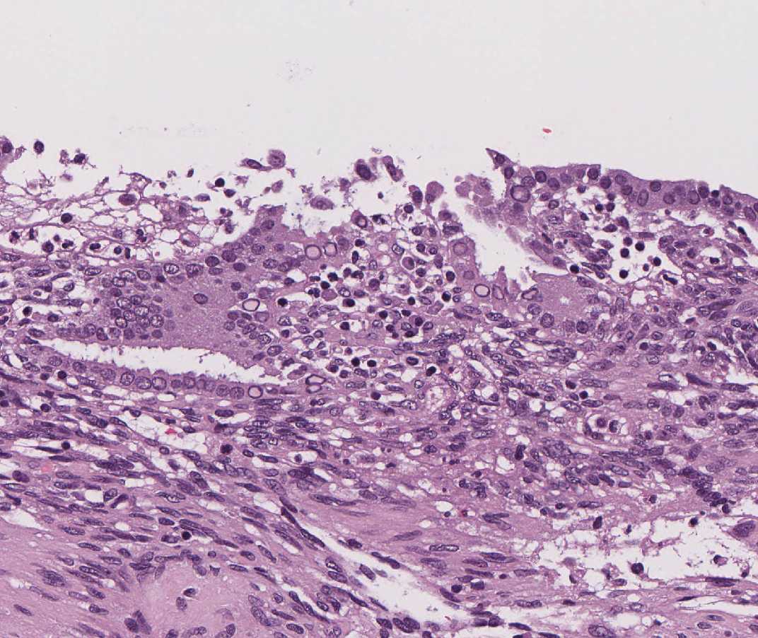 Imagen de Histerectoma procedente de paciente joven/Hysterectomy specimen from young female.
