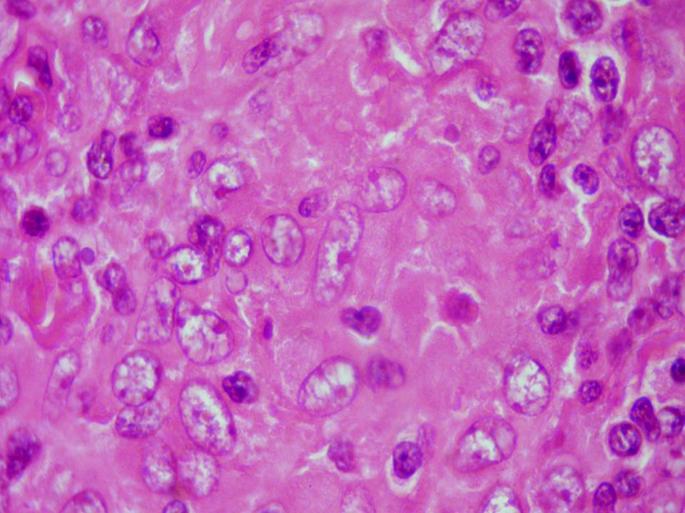 Imagen de Ganglio linftico cervical en mujer de 36 aos/Cervical lymph node in 36 y-o female.